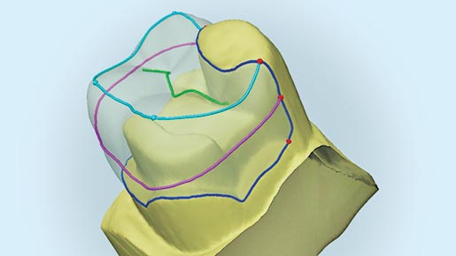 cerec computer design of a dental crown