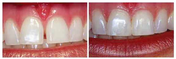 closing a space between two front teeth with dental bonding