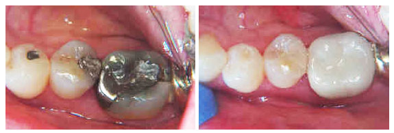 replacing silver crowns with ceramic crowns